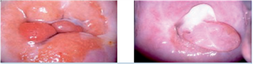 Cervical polyps