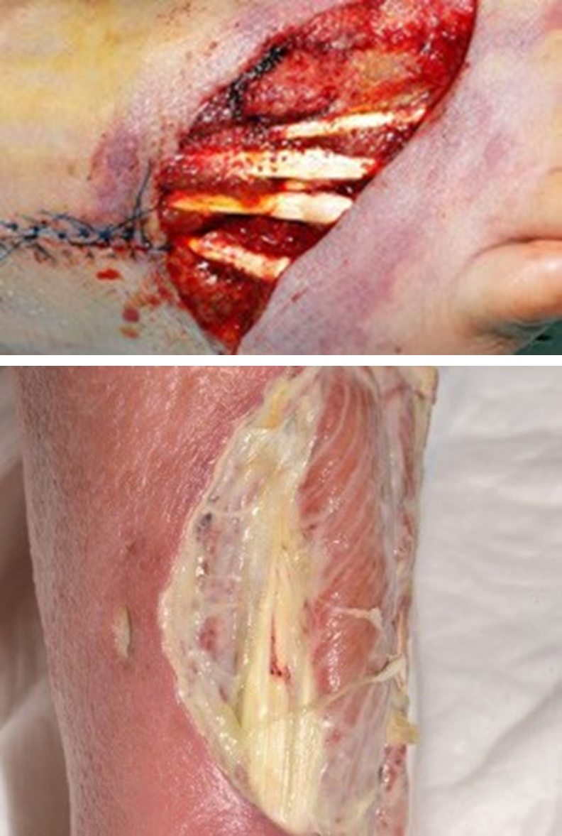 Tendon