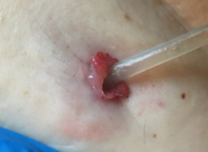 Hypergranulating
