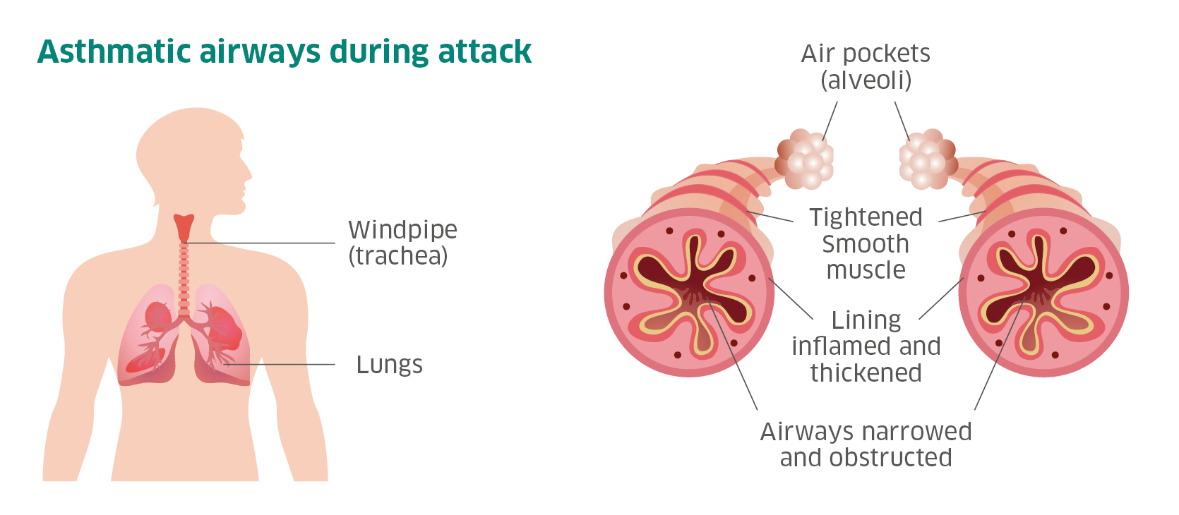 Image of asthmatic airways during attack