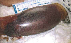 Closed haematoma