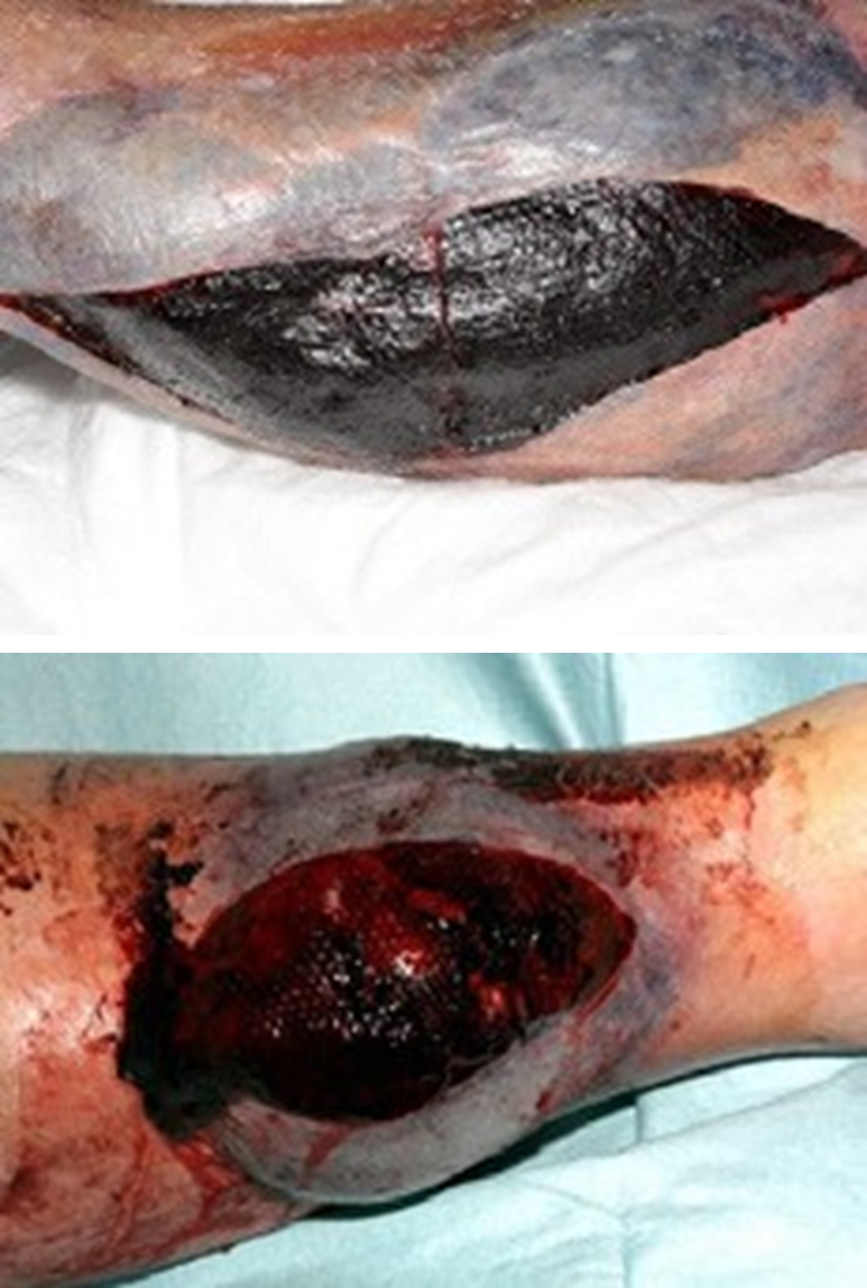 Haematoma